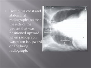 

Decubitus chest and
abdominal
radiographs: so that
the side of the
patient that was
positioned upward
when radiograph
was taken is upward
on the hung
radiograph.

 