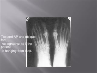 Toe and AP and oblique
foot
radiographs: as if the
patient
is hanging from toes.

 