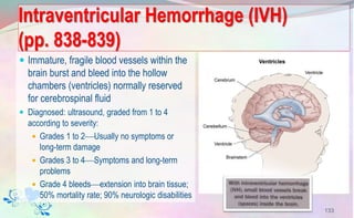 Intraventricular Hemorrhage (IVH)
(pp. 838-839)
 Immature, fragile blood vessels within the
brain burst and bleed into the hollow
chambers (ventricles) normally reserved
for cerebrospinal fluid
 Diagnosed: ultrasound, graded from 1 to 4
according to severity:
 Grades 1 to 2Usually no symptoms or
long-term damage
 Grades 3 to 4Symptoms and long-term
problems
 Grade 4 bleedsextension into brain tissue;
50% mortality rate; 90% neurologic disabilities
133
 