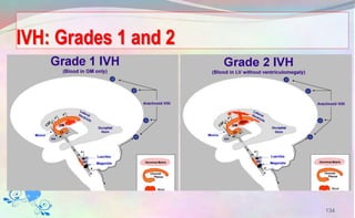 IVH: Grades 1 and 2
134
 