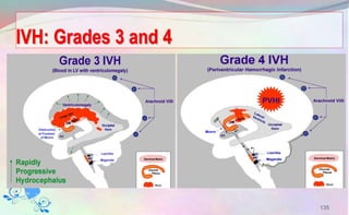 IVH: Grades 3 and 4
135
 