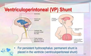 Ventriculoperintoneal (VP) Shunt
137
• For persistent hydrocephalus: permanent shunt is
placed in the ventricle (ventriculoperitoneal shunt)
 