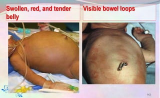 Swollen, red, and tender
belly
142
Visible bowel loops
 