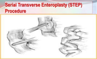 Serial Transverse Enteroplasty (STEP)
Procedure
145
 