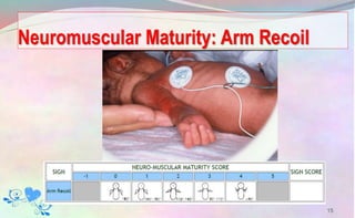 Neuromuscular Maturity: Arm Recoil
15
 