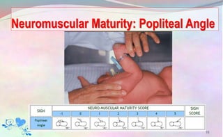 Neuromuscular Maturity: Popliteal Angle
16
 