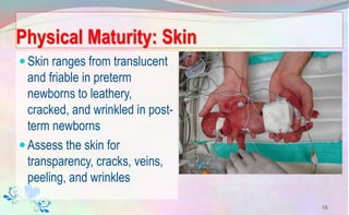 Physical Maturity: Skin
Skin ranges from translucent
and friable in preterm
newborns to leathery,
cracked, and wrinkled in post-
term newborns
Assess the skin for
transparency, cracks, veins,
peeling, and wrinkles
19
 