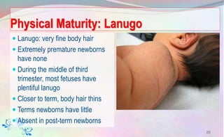 Physical Maturity: Lanugo
 Lanugo: very fine body hair
 Extremely premature newborns
have none
 During the middle of third
trimester, most fetuses have
plentiful lanugo
 Closer to term, body hair thins
 Terms newborns have little
 Absent in post-term newborns
20
 