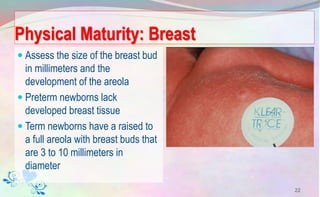 Physical Maturity: Breast
 Assess the size of the breast bud
in millimeters and the
development of the areola
 Preterm newborns lack
developed breast tissue
 Term newborns have a raised to
a full areola with breast buds that
are 3 to 10 millimeters in
diameter
22
 