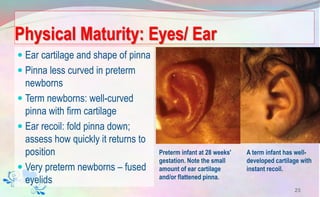 Physical Maturity: Eyes/ Ear
 Ear cartilage and shape of pinna
 Pinna less curved in preterm
newborns
 Term newborns: well-curved
pinna with firm cartilage
 Ear recoil: fold pinna down;
assess how quickly it returns to
position
 Very preterm newborns – fused
eyelids
23
A term infant has well-
developed cartilage with
instant recoil.
Preterm infant at 28 weeks'
gestation. Note the small
amount of ear cartilage
and/or flattened pinna.
 