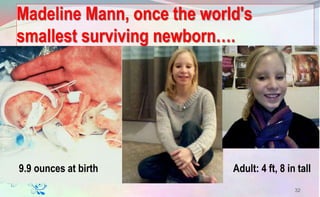 Madeline Mann, once the world's
smallest surviving newborn….
32
9.9 ounces at birth Adult: 4 ft, 8 in tall
 