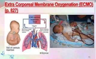Extra Corporeal Membrane Oxygenation (ECMO)
(p. 827)
53
 