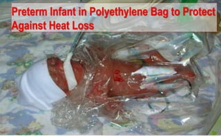72
Preterm Infant in Polyethylene Bag to Protect
Against Heat Loss
 