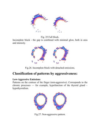 Fig. 25 Full block.
Incomplete block - the gap is combined with minimal glow, both in area
and intensity.
Fig.26. Incomplete block with detached emissions.
Classification of patterns by aggressiveness:
Low-Aggressive Emissions
Patterns on the contour of the finger (non-aggressive). Corresponds to the
chronic processes — for example, hypofunction of the thyroid gland –
hypothyroidism.
Fig.27. Non-aggressive pattern.
 