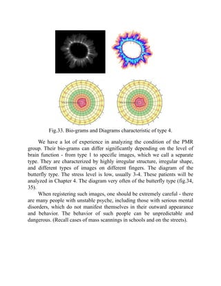Fig.33. Bio-grams and Diagrams characteristic of type 4.
We have a lot of experience in analyzing the condition of the PMR
group. Their bio-grams can differ significantly depending on the level of
brain function - from type 1 to specific images, which we call a separate
type. They are characterized by highly irregular structure, irregular shape,
and different types of images on different fingers. The diagram of the
butterfly type. The stress level is low, usually 3-4. These patients will be
analyzed in Chapter 4. The diagram very often of the butterfly type (fig.34,
35).
When registering such images, one should be extremely careful - there
are many people with unstable psyche, including those with serious mental
disorders, which do not manifest themselves in their outward appearance
and behavior. The behavior of such people can be unpredictable and
dangerous. (Recall cases of mass scannings in schools and on the streets).
 