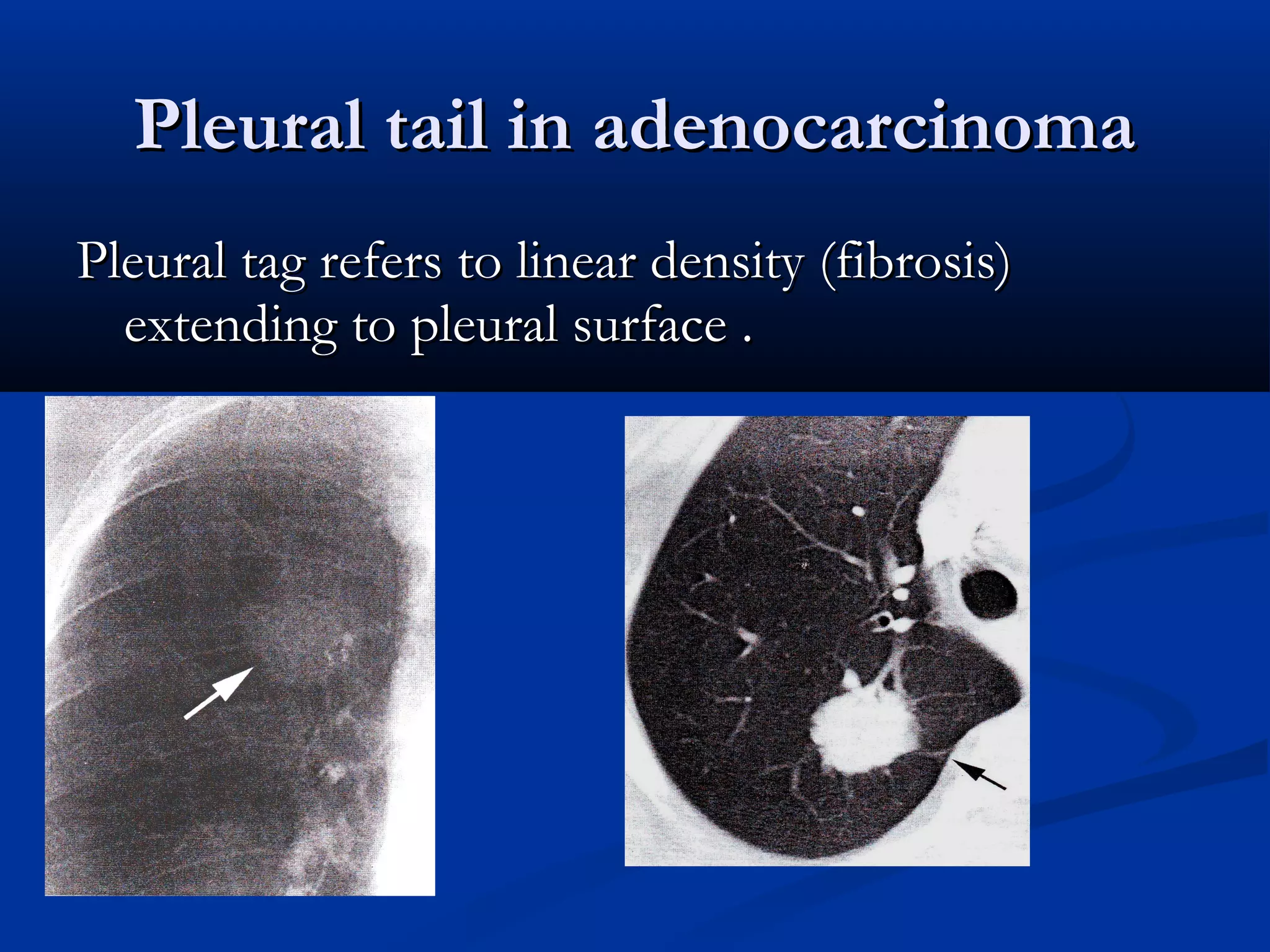 Pleural tail in adenocarcinoma
Pleural tag refers to linear density (fibrosis)
  extending to pleural surface .
 