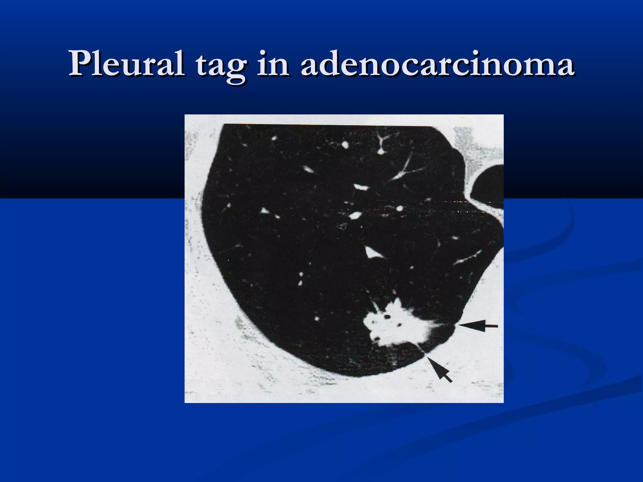 Pleural tag in adenocarcinoma
 