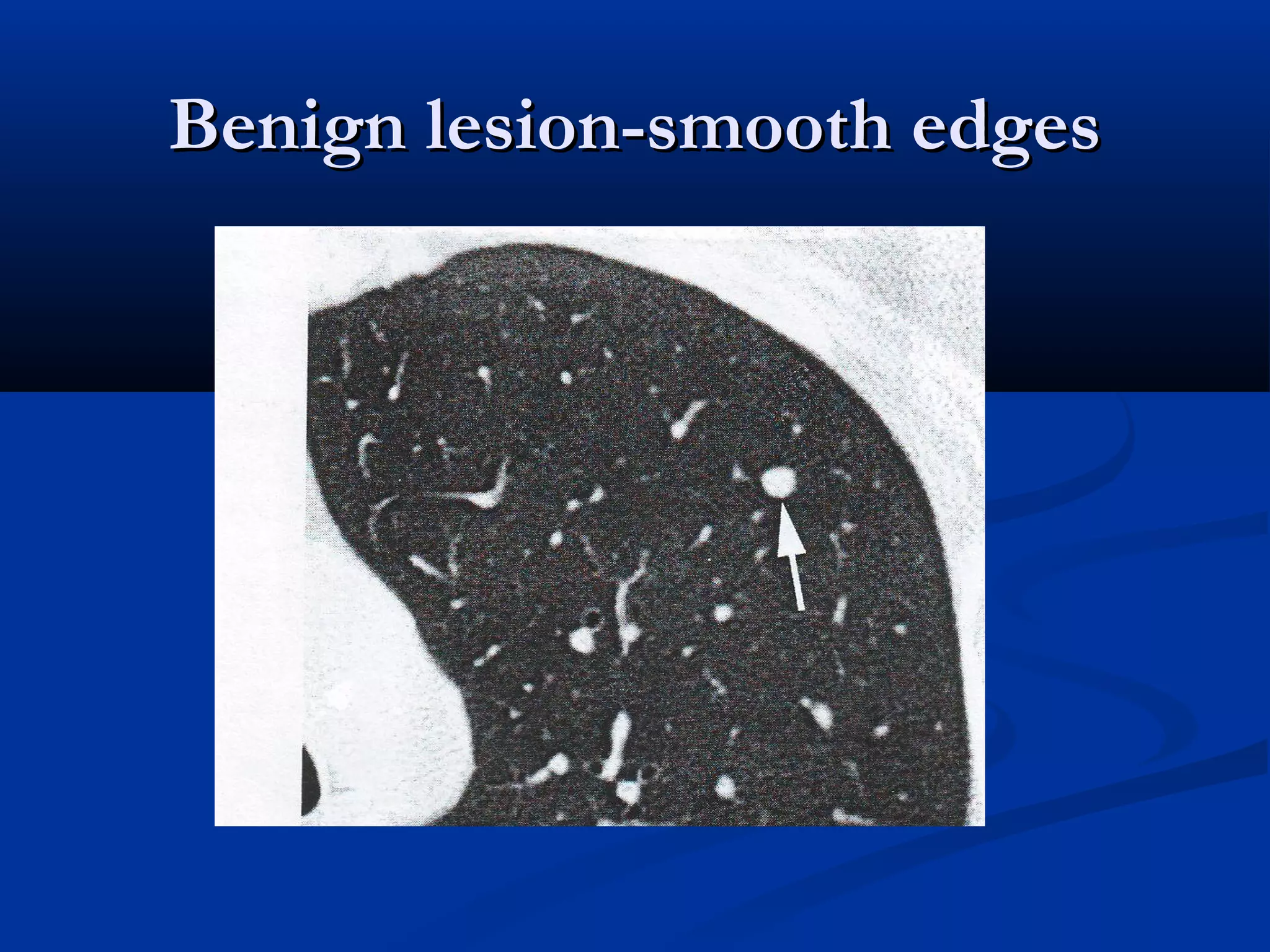 Benign lesion-smooth edges
 