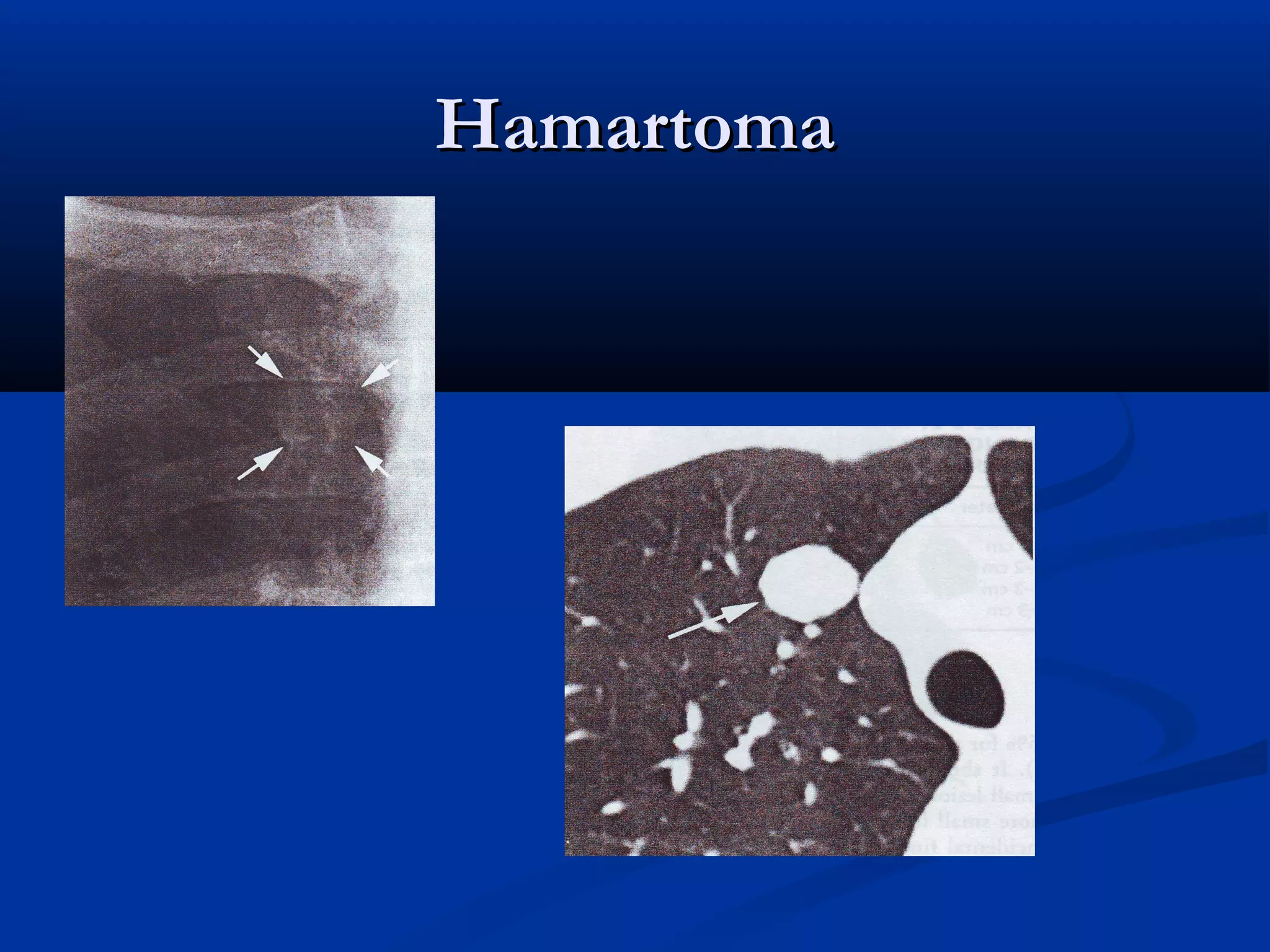 Hamartoma
 