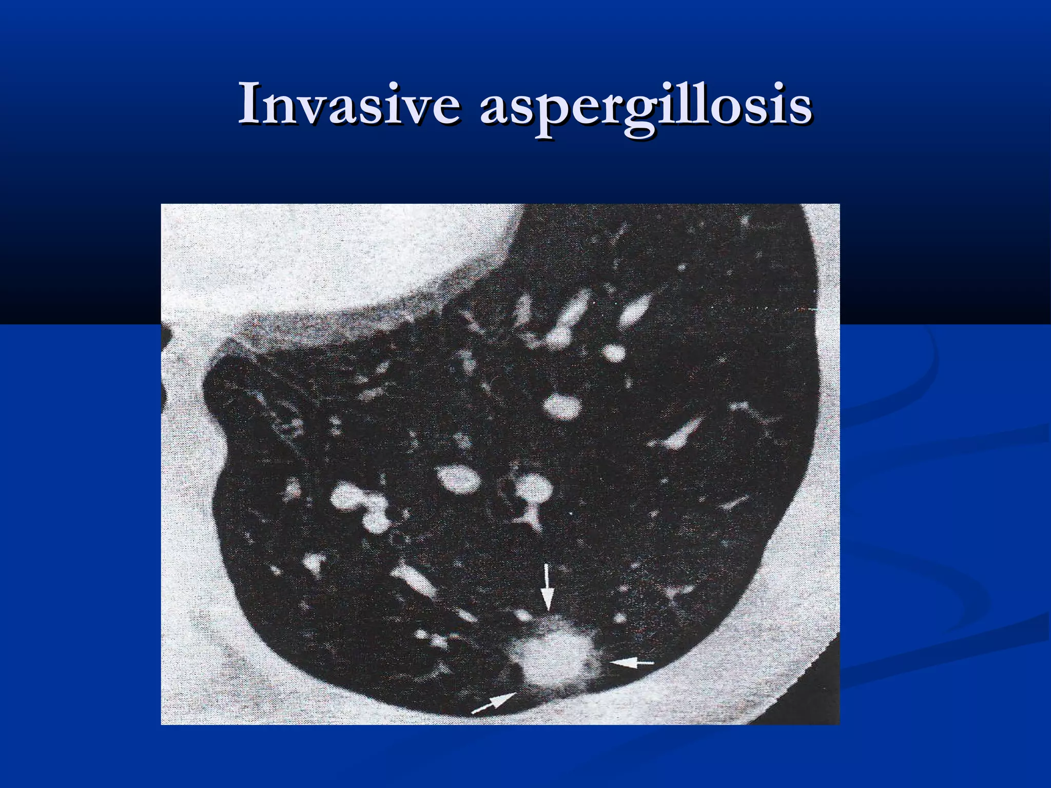 Invasive aspergillosis
 