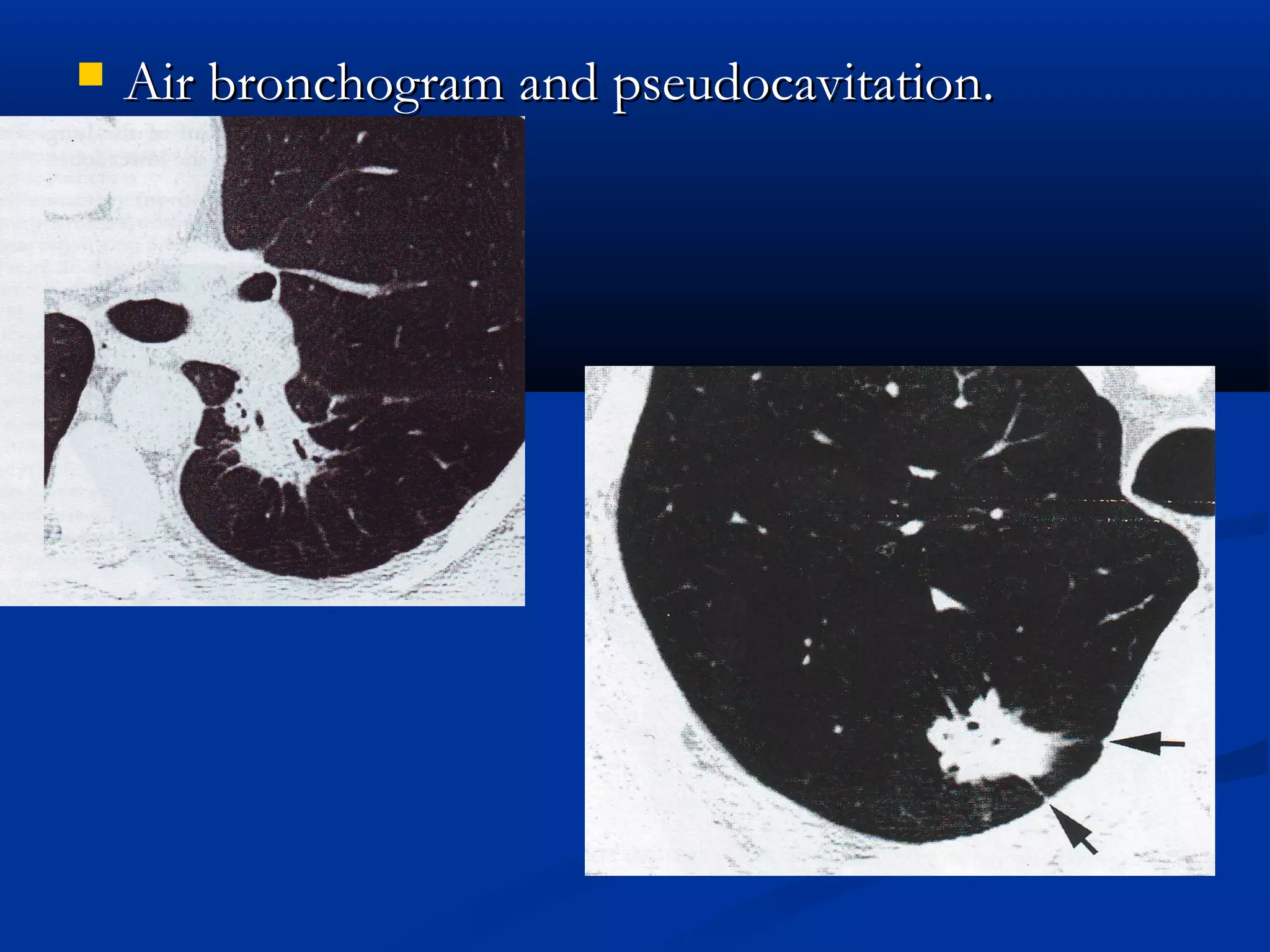    Air bronchogram and pseudocavitation.
 