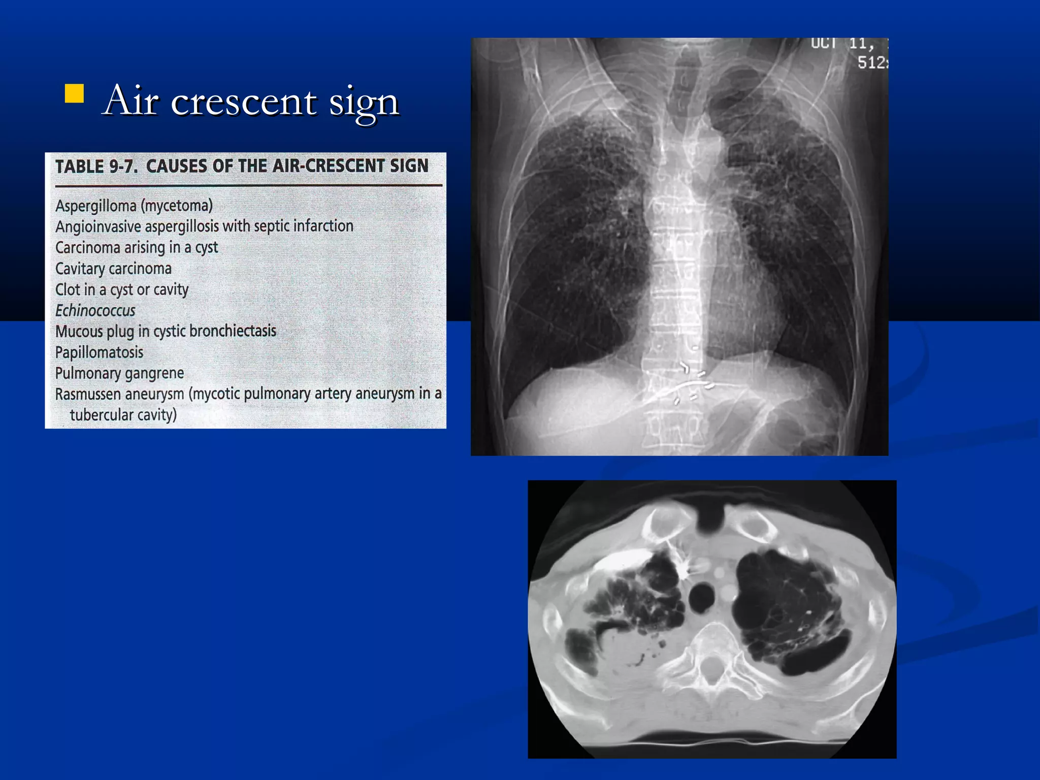    Air crescent sign
 