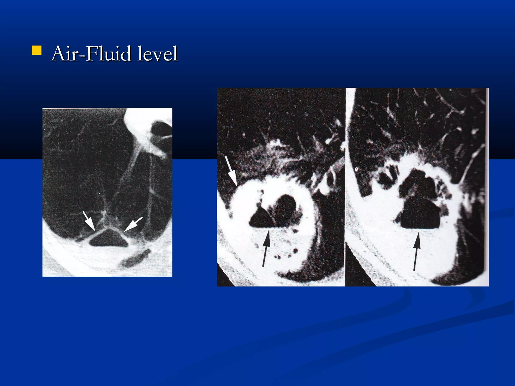    Air-Fluid level
 