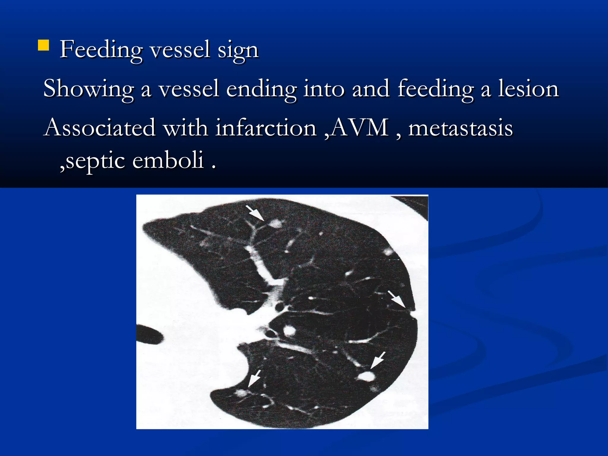 Feeding vessel sign
Showing a vessel ending into and feeding a lesion
Associated with infarction ,AVM , metastasis
 ,septic emboli .
 