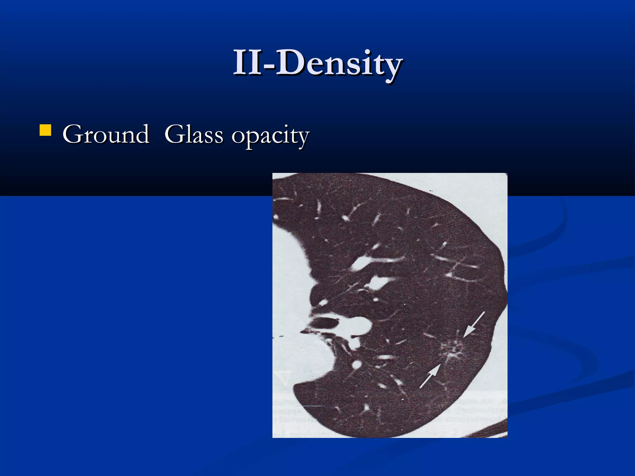 II-Density
   Ground Glass opacity
 