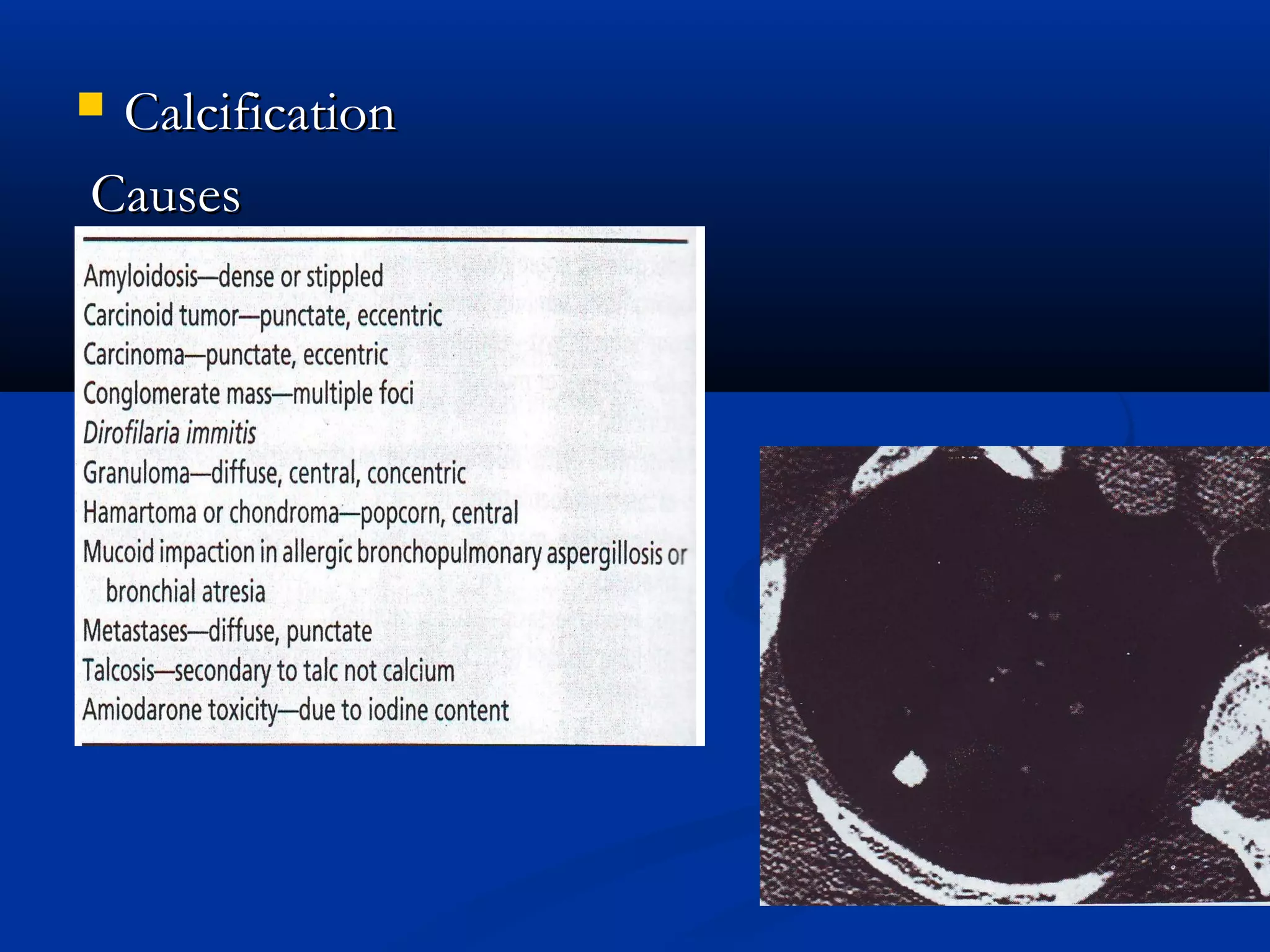 Calcification
Causes
 