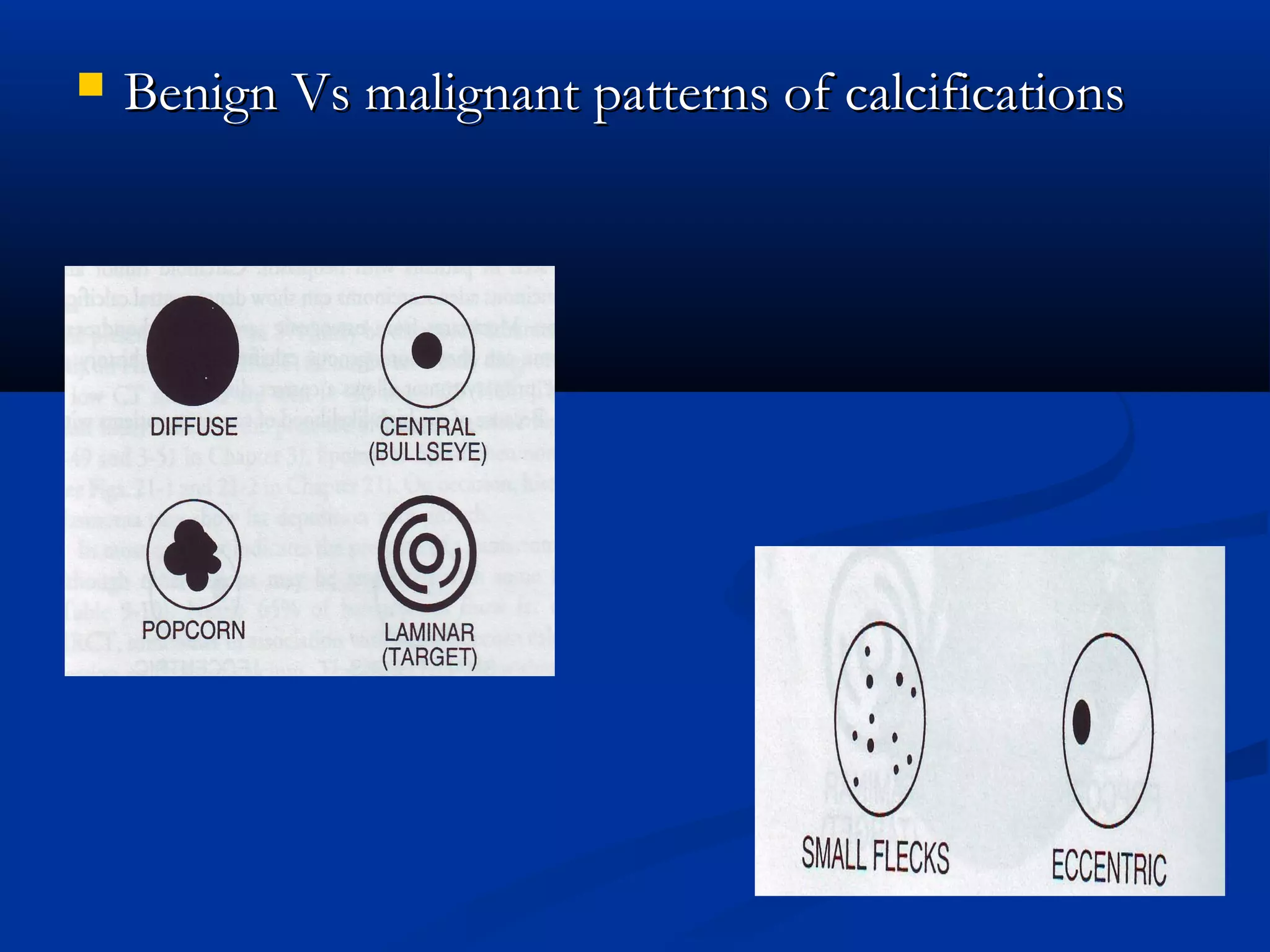    Benign Vs malignant patterns of calcifications
 