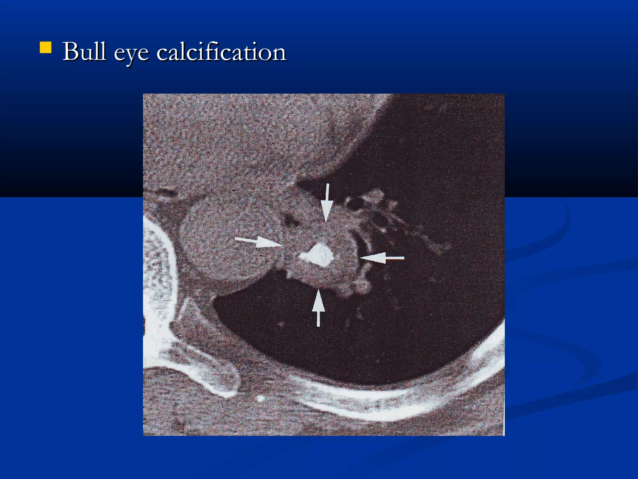    Bull eye calcification
 