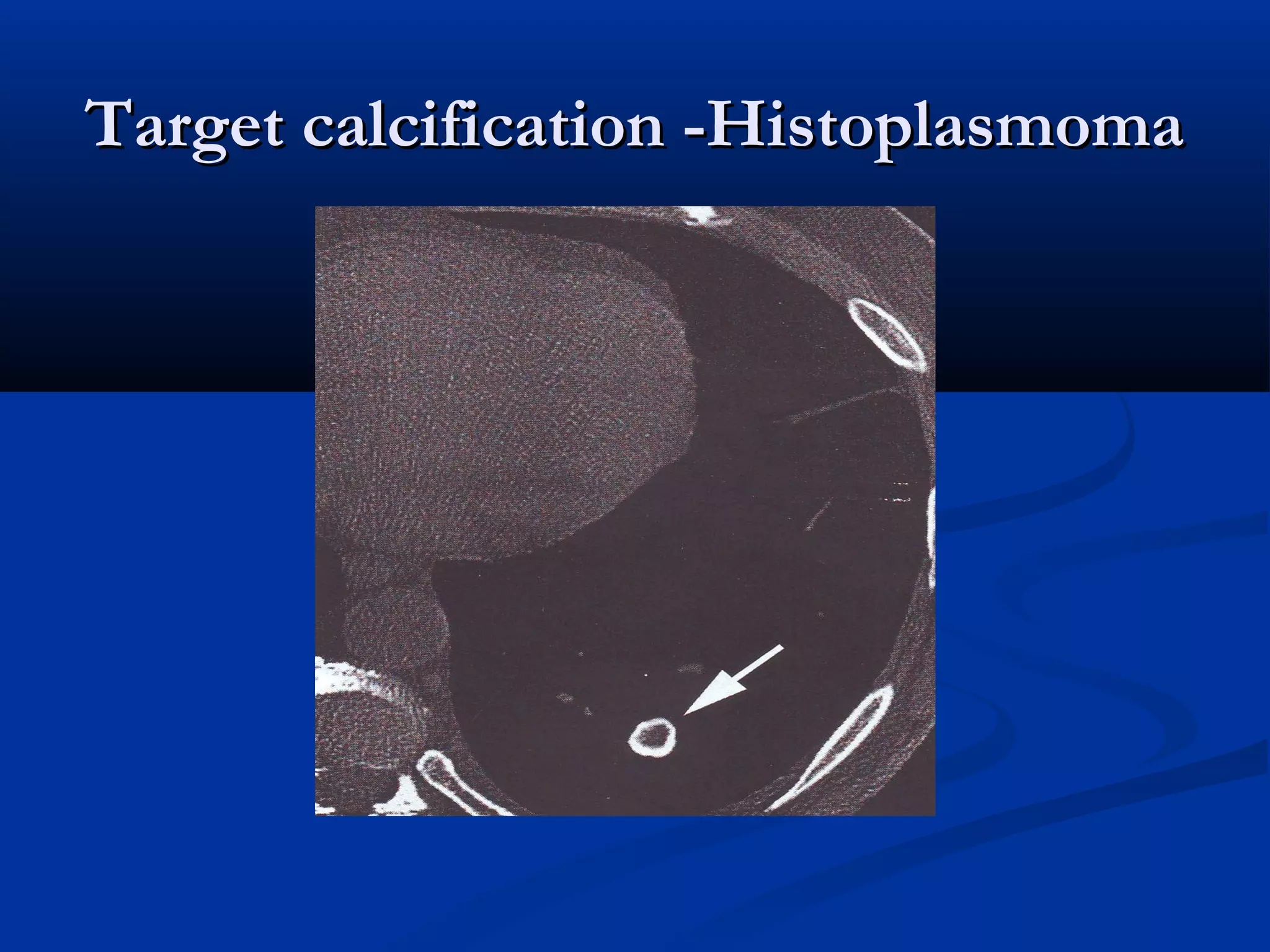Target calcification -Histoplasmoma
 
