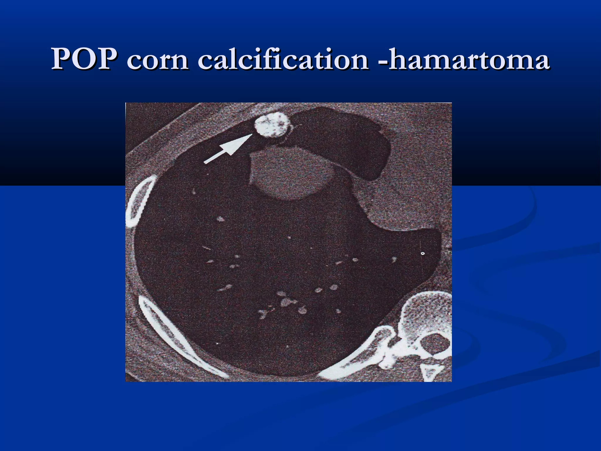 POP corn calcification -hamartoma
 