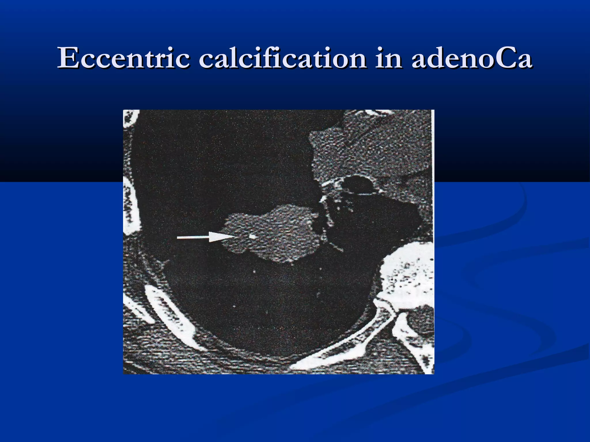 Eccentric calcification in adenoCa
 