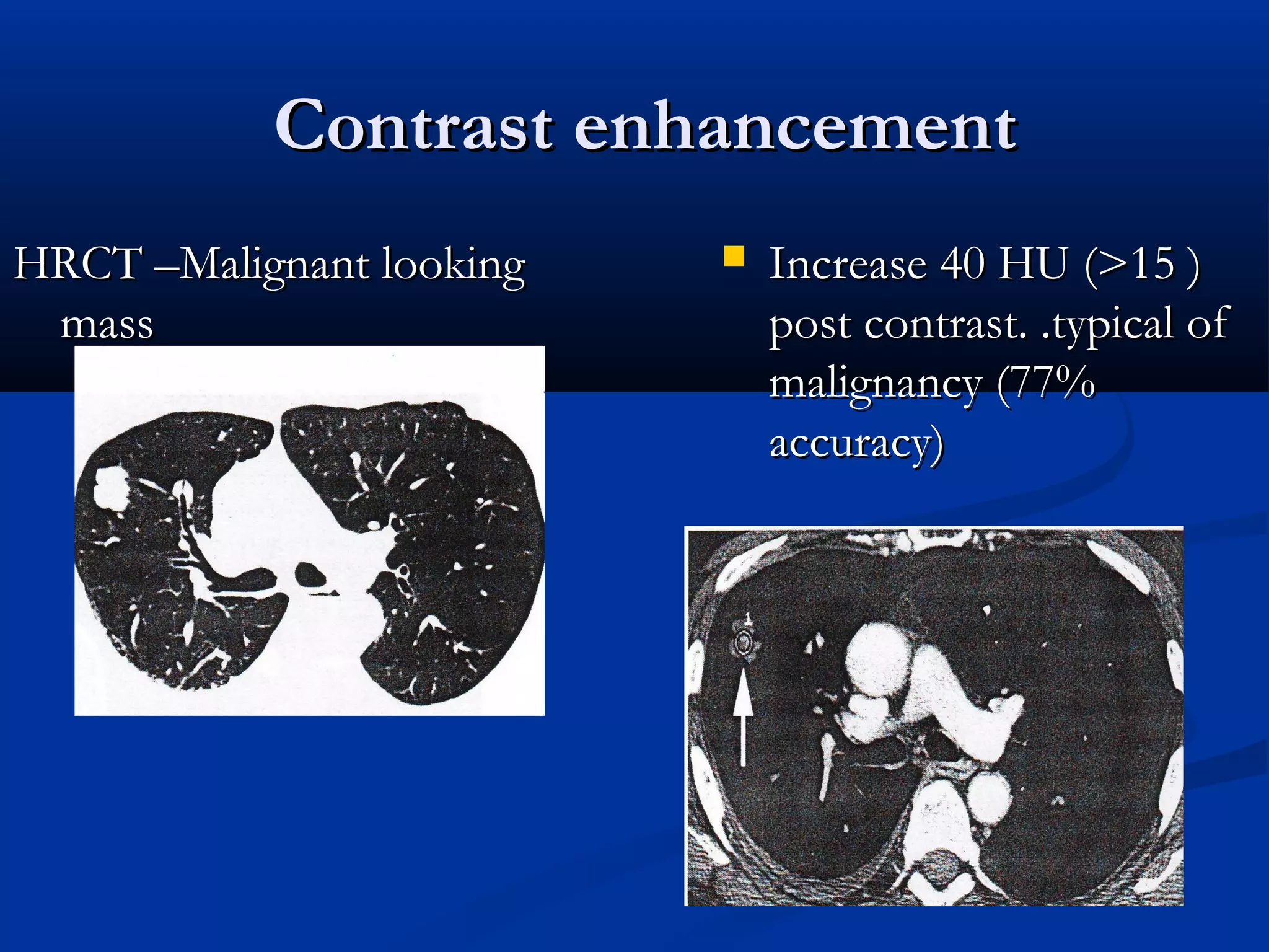 Contrast enhancement
HRCT –Malignant looking      Increase 40 HU (>15 )
 mass                         post contrast. .typical of
                              malignancy (77%
                              accuracy)
 