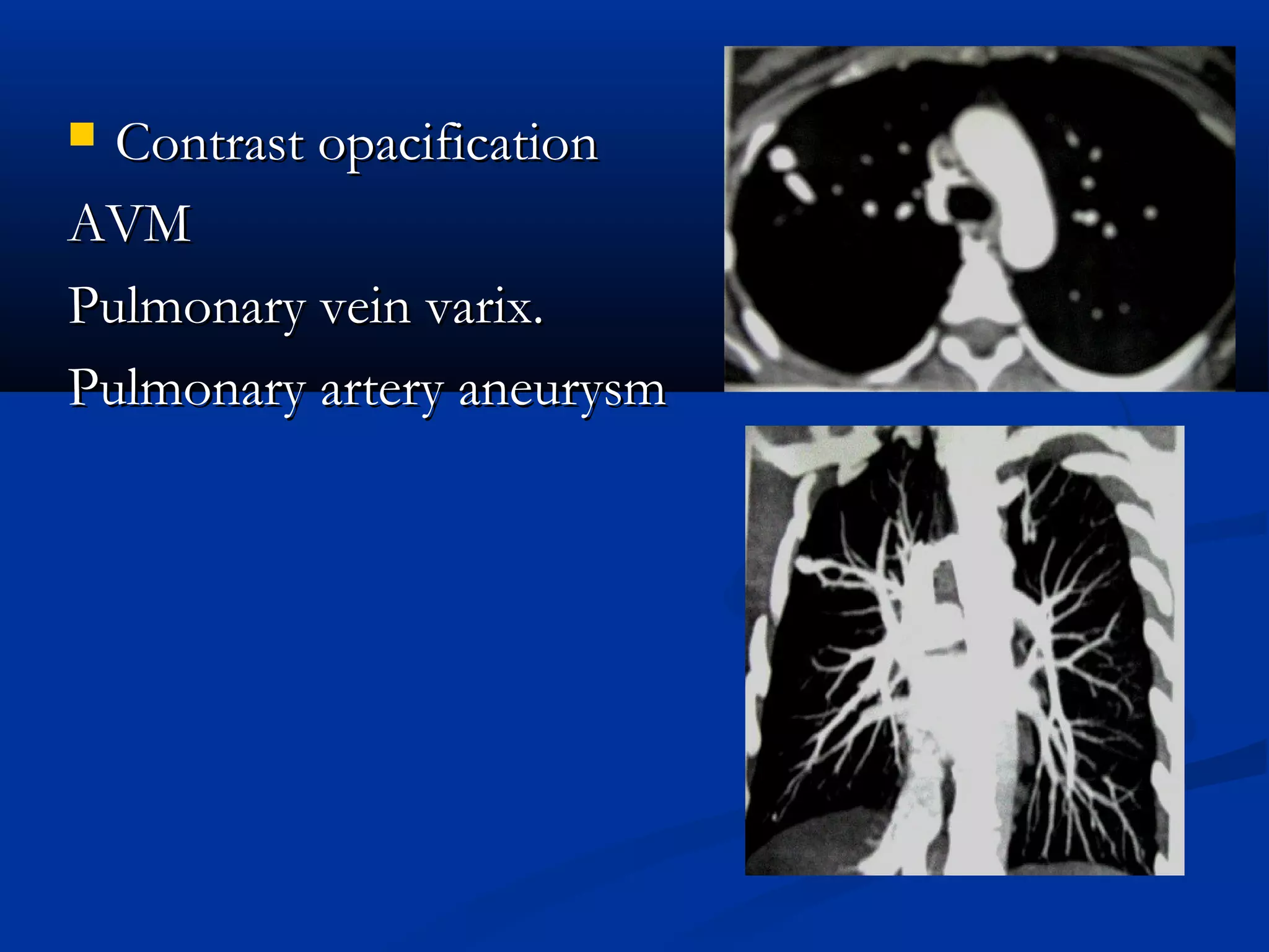  Contrast opacification
AVM
Pulmonary vein varix.
Pulmonary artery aneurysm
 