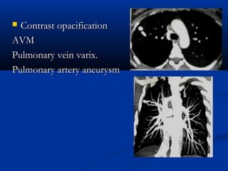The problem of solitary pulmonary nodule. | PPT