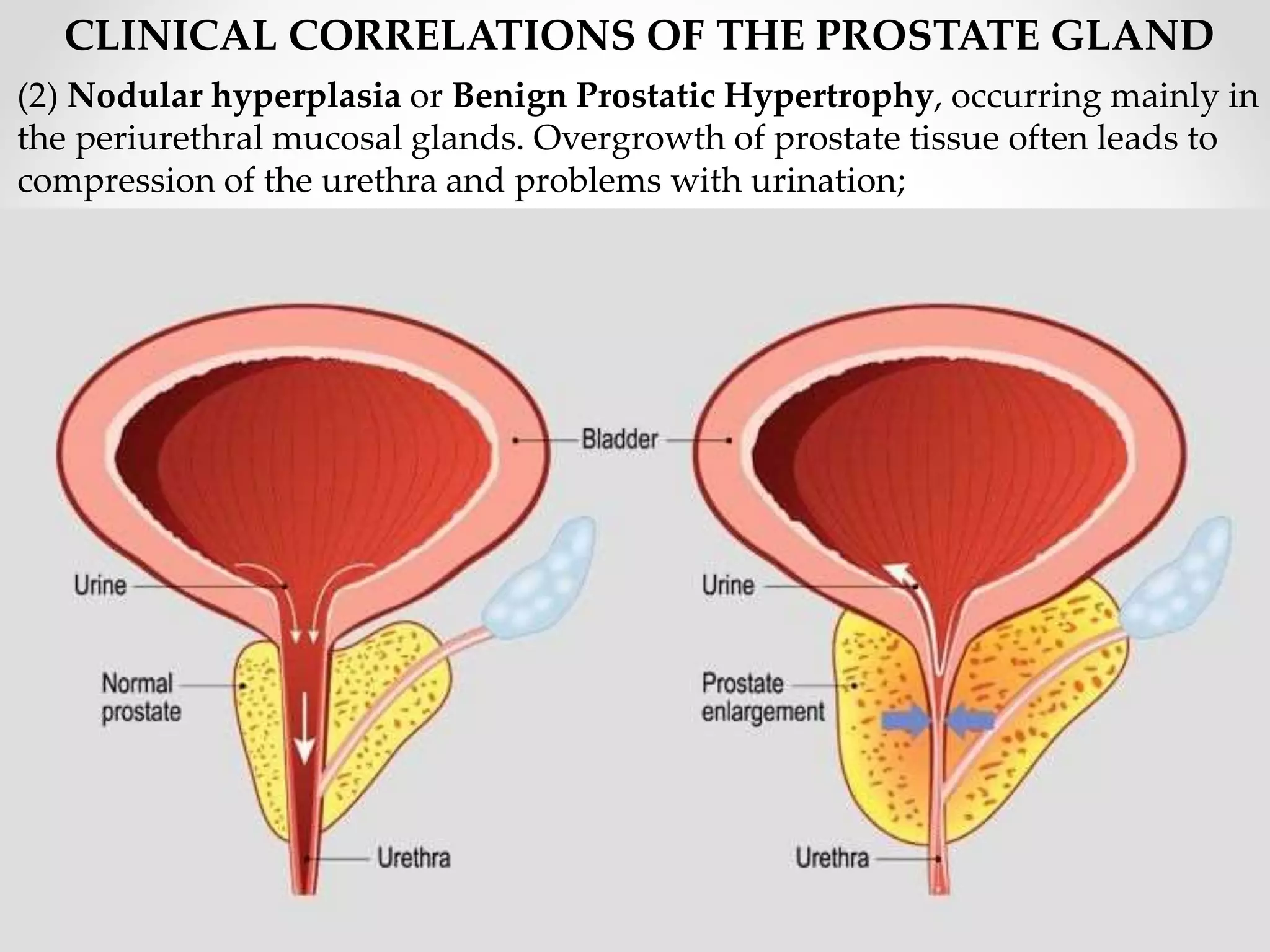 Prostate Compression The Prostate Gland.pptx