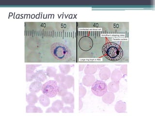 Plasmodium vivax
 