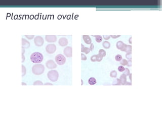 Plasmodium ovale
 