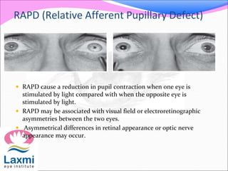 Afferent Pupil Defect , Relative afferent pupillary defect – GXXKE