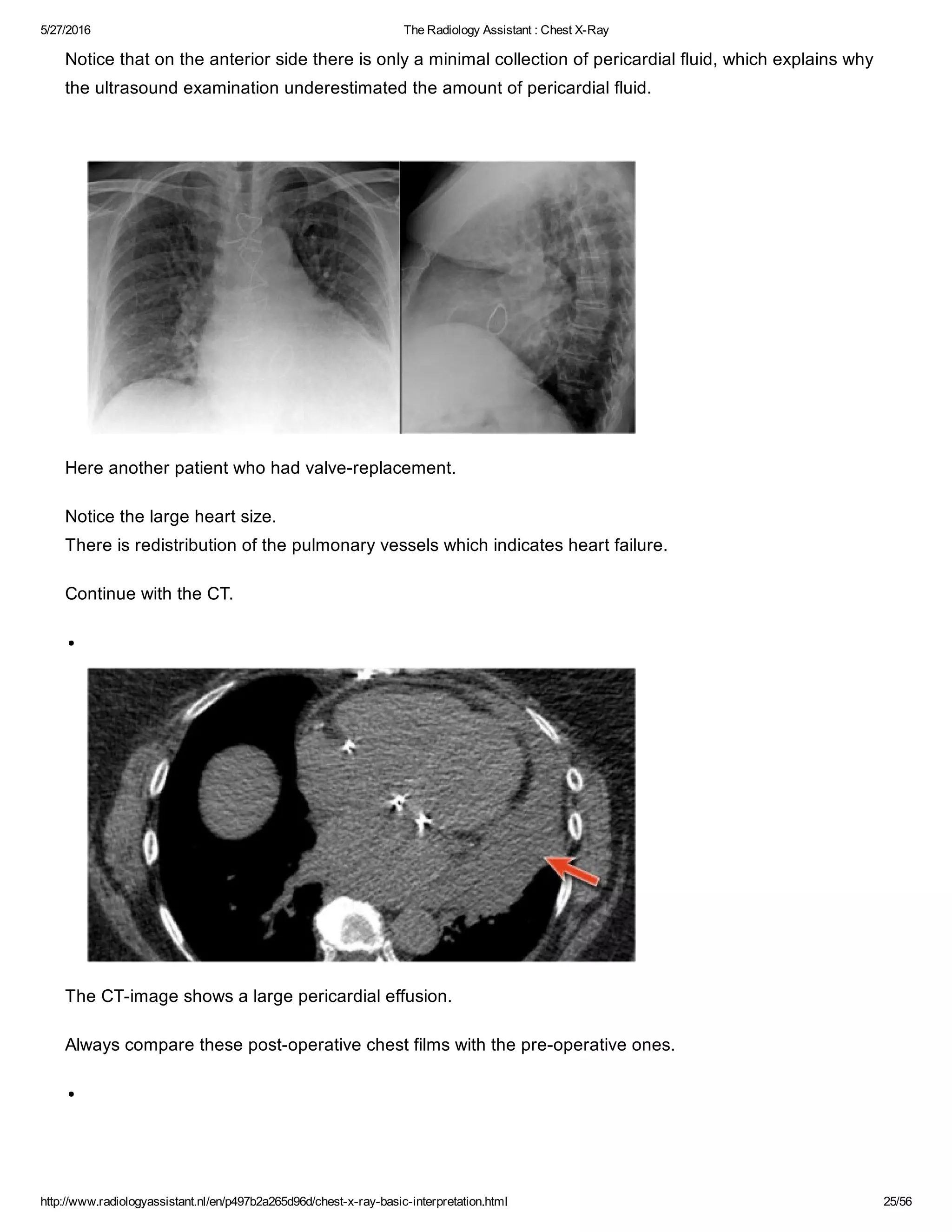The radiology assistant chest x ray - basic interpretation | PDF