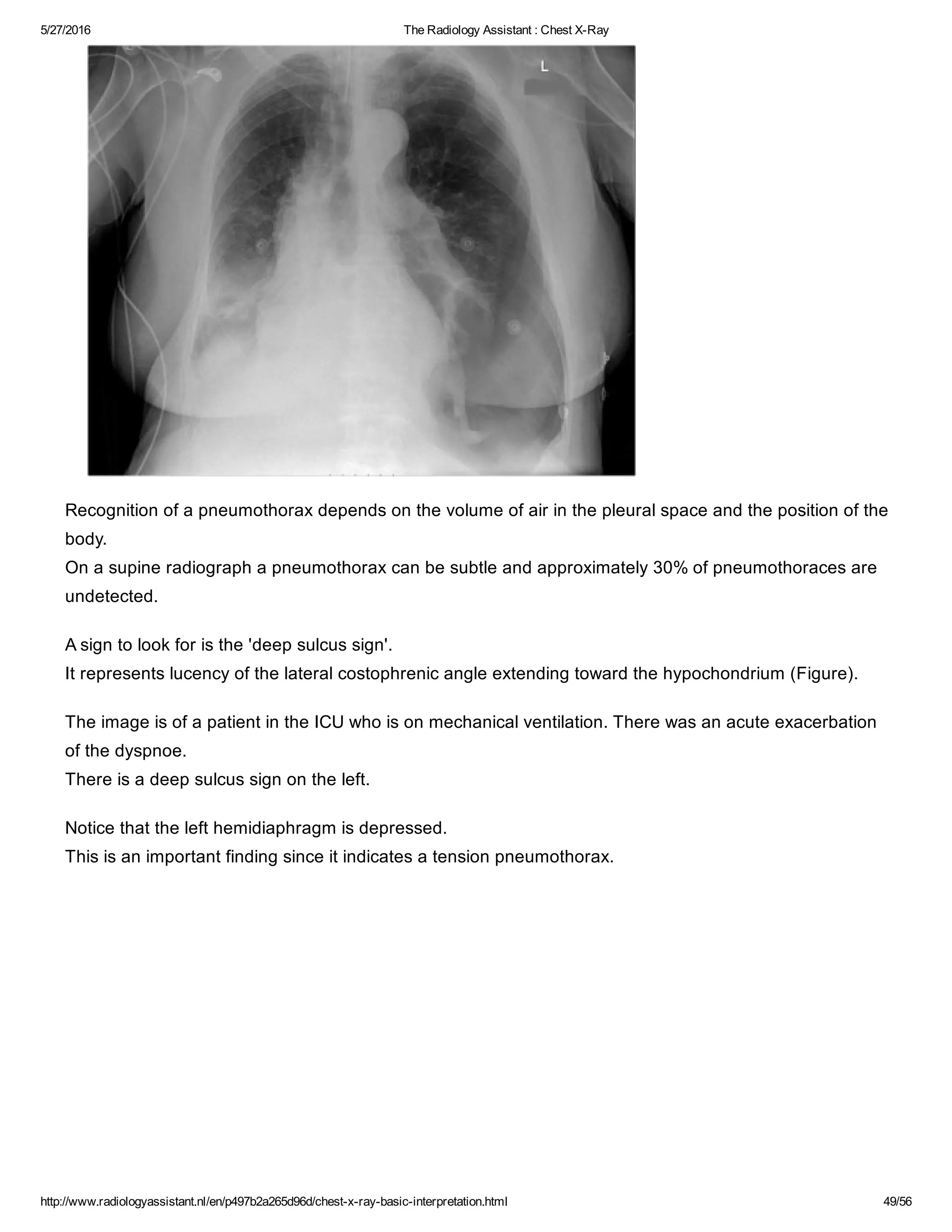 The radiology assistant chest x ray - basic interpretation | PDF
