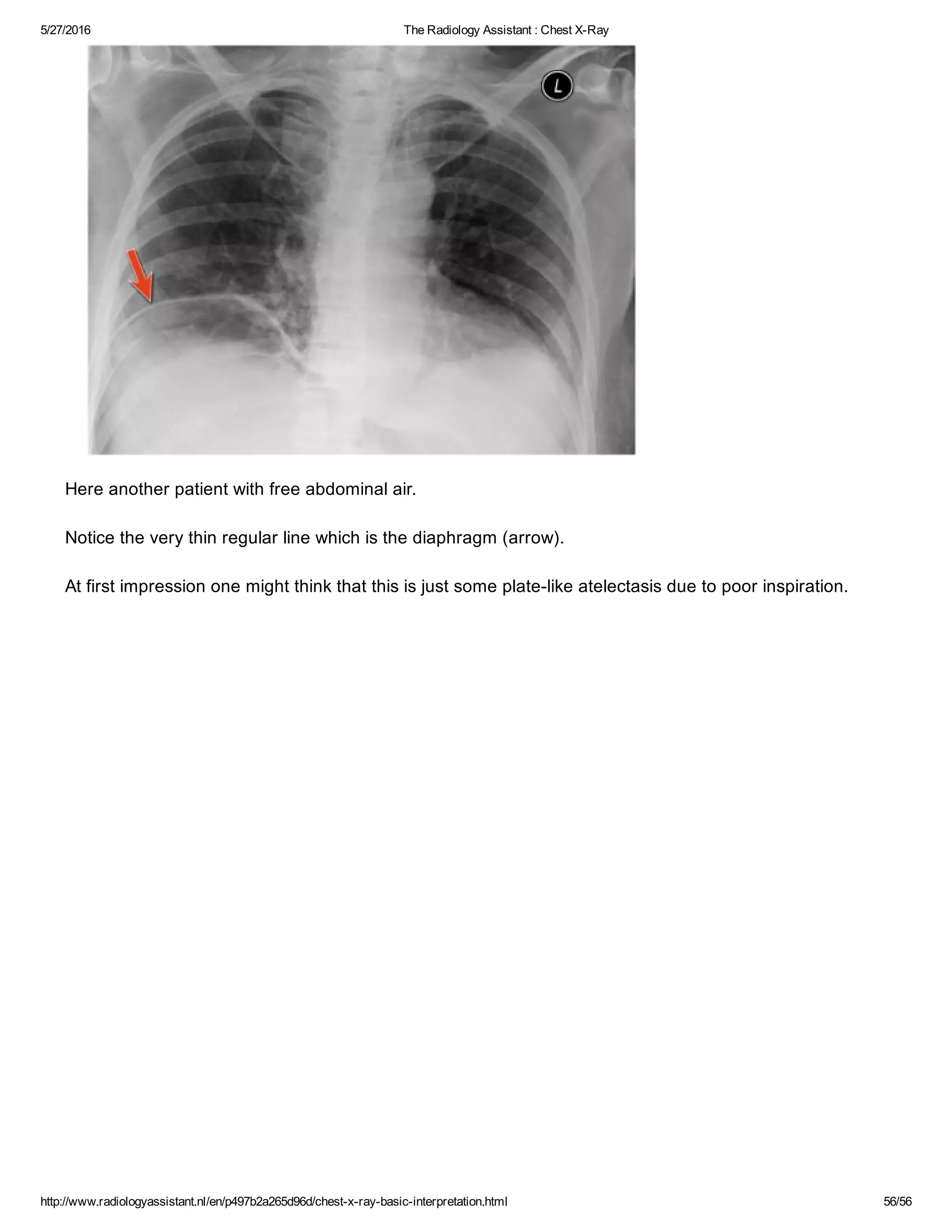 The radiology assistant chest x ray - basic interpretation | PDF