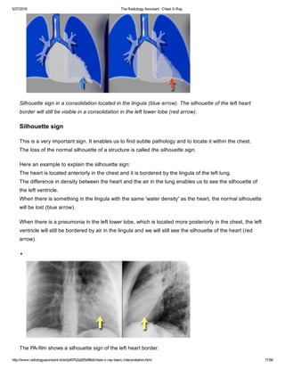 The radiology assistant chest x ray - basic interpretation | PDF