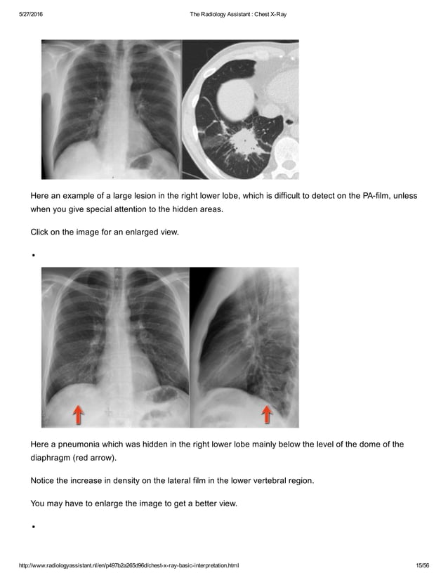 The radiology assistant chest x ray - basic interpretation | PDF