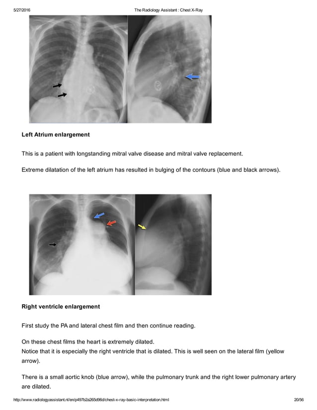 The radiology assistant chest x ray - basic interpretation | PDF