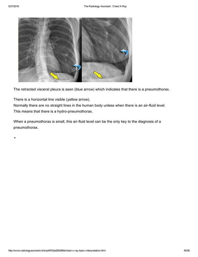 The radiology assistant chest x ray - basic interpretation | PDF