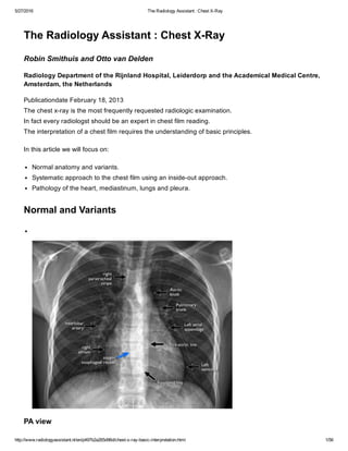 5/27/2016 The Radiology Assistant : Chest X­Ray
http://www.radiologyassistant.nl/en/p497b2a265d96d/chest­x­ray­basic­interpretation.html 1/56
The Radiology Assistant : Chest X­Ray
Robin Smithuis and Otto van Delden
Radiology Department of the Rijnland Hospital, Leiderdorp and the Academical Medical Centre,
Amsterdam, the Netherlands
Publicationdate February 18, 2013
The chest x­ray is the most frequently requested radiologic examination.
In fact every radiologst should be an expert in chest film reading.
The interpretation of a chest film requires the understanding of basic principles.
In this article we will focus on:
Normal anatomy and variants.
Systematic approach to the chest film using an inside­out approach.
Pathology of the heart, mediastinum, lungs and pleura.
Normal and Variants
PA view
 
